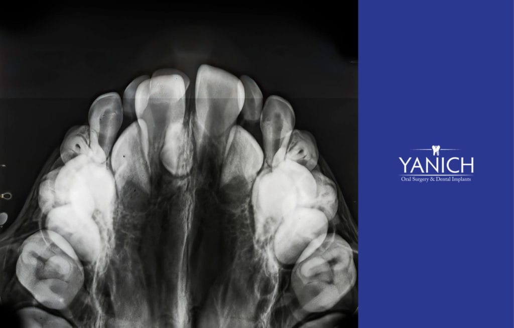image of a dental X-Ray