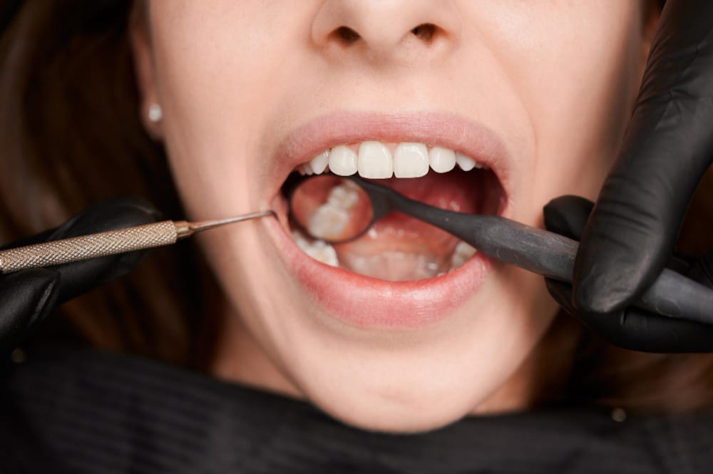image of girls mouth locating the wisdom tooth