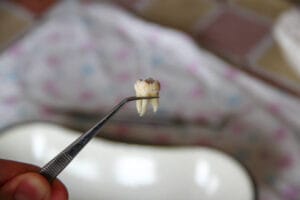 A close-up of dental forceps holding a tooth.