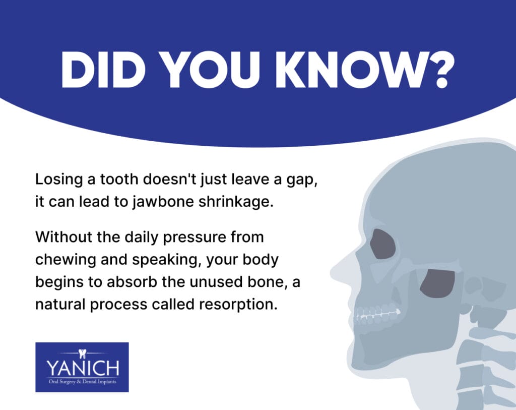 Educational dental graphic explaining how losing a tooth can cause jawbone shrinkage and bone resorption over time.