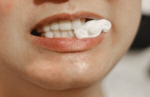 Close-up of patient’s mouth with gauze pad between teeth after a dental extraction to control bleeding and aid healing.